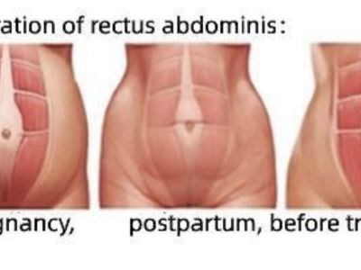 Body-sculpt (HIFEM)